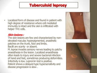 • Localized form of disease and found in patient with
high degree of resistance where cell mediated
immunity is intact and the skin is infiltrated with
helper TH1 cells.
Skin lesions :
The skin lesions are few and characterized by non-
elevated macular, hyperpigmented, anasthetic
patches on the trunk, face and limbs.
Bacilli are scanty or absent.
M. leprae invades sensory nerves leading to patchy
anaesthesia in the lesion. Localized anaesthesia
often leads to injury and severe bacterial infection
of hand and feet, sometimes producing deformities.
Infectivity is low. Lepromin test is positive.
Patient shows a delayed type hypersensitivity and
disease progression is slow .
Tuberculoid leprosy
 