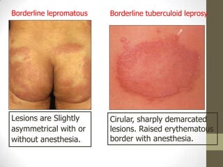 Borderline tuberculoid leprosyBorderline lepromatous
Lesions are Slightly
asymmetrical with or
without anesthesia.
Cirular, sharply demarcated
lesions. Raised erythematous
border with anesthesia.
 