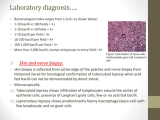 Laboratorydiagnosis…..
• Bacteriological index ranges from 1 to 6+ as shown below:
• 1-10 bacilli in 100 fields = 1+
• 1-10 bacilli in 10 fields = 2+
• 1-10 bacilli per field = 3+
• 10-100 bacilli per field = 4+
• 100-1,000 bacilli per filed = 5+
• More than 1,000 bacilli, clumps and groups in every field = 6+
II. Skin and nerve biopsy:
• skin biopsy is collected from active edge of the patches and nerve biopsy from
thickened nerve for histological confirmation of tuberculoid leprosy when acid
fast bacilli can not be demonstrated by direct smear.
• Microscopically:
(a) Tuberculoid leprosy shows infiltration of lymphocytes around the center of
epithelial cells; presence of Langhan’s giant cells; few or no acid fast bacilli.
(b) Lepromatous leprosy shows predominantly foamy macrophage (lepra cell) with
few lymphocyte and no giant cells.
Figure: Granulation of tissue with
multinucleate giant cell (Langhan’s
cell
 