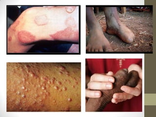 Mycobacterium leprae