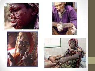 Mycobacterium leprae