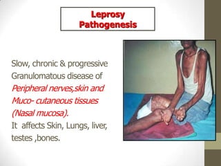 Slow, chronic & progressive
Granulomatous disease of
Peripheral nerves,skin and
Muco- cutaneous tissues
(Nasal mucosa).
It affects Skin, Lungs, liver,
testes ,bones.
Leprosy
Pathogenesis
 