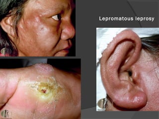 Lepromatous leprosy
 