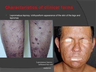Characteristics of clinical forms
 Lepromatous leprosy: ichthyosiform appearance of the skin of the legs and
lepromas
Lepromatous leprosy:
infiltrated face and
madarosis
 