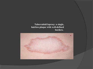 Tuberculoid leprosy: a single,
hairless plaque with well-defined
borders.
 