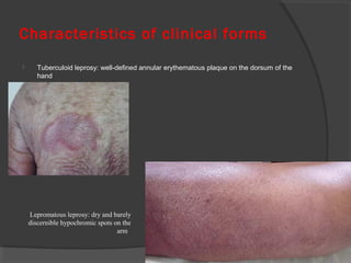Characteristics of clinical forms
 Tuberculoid leprosy: well-defined annular erythematous plaque on the dorsum of the
hand
Lepromatous leprosy: dry and barely
discernible hypochromic spots on the
arm
 