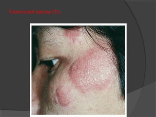 Tuberculoid leprosy (TL)
 