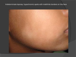  Indeterminate leprosy: hypochromic spots with indefinite borders on the face 
 