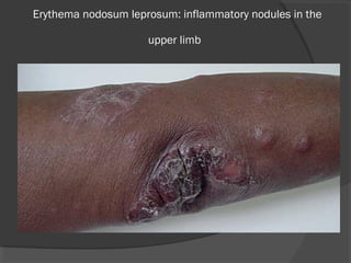 Erythema nodosum leprosum: inflammatory nodules in the
upper limb 
 