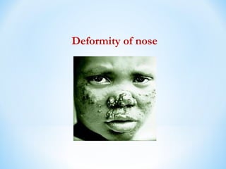 Deformity of nose
 