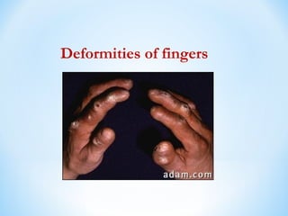 Deformities of fingers
 