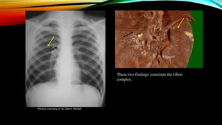 These two findings constitute the Ghon
complex.
Photos courtesy of Dr Glenn Merkel
 