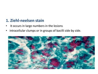 1. Ziehl-neelsen stain
• It occurs in large numbers in the lesions
• intracellular clumps or in groups of bacilli side by side.
 