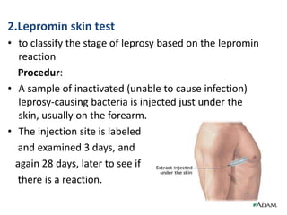 2.Lepromin skin test
• to classify the stage of leprosy based on the lepromin
reaction
Procedur:
• A sample of inactivated (unable to cause infection)
leprosy-causing bacteria is injected just under the
skin, usually on the forearm.
• The injection site is labeled
and examined 3 days, and
again 28 days, later to see if
there is a reaction.
 