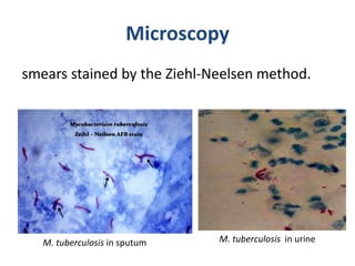 Microscopy
smears stained by the Ziehl-Neelsen method.
M. tuberculosis in urineM. tuberculosis in sputum
 