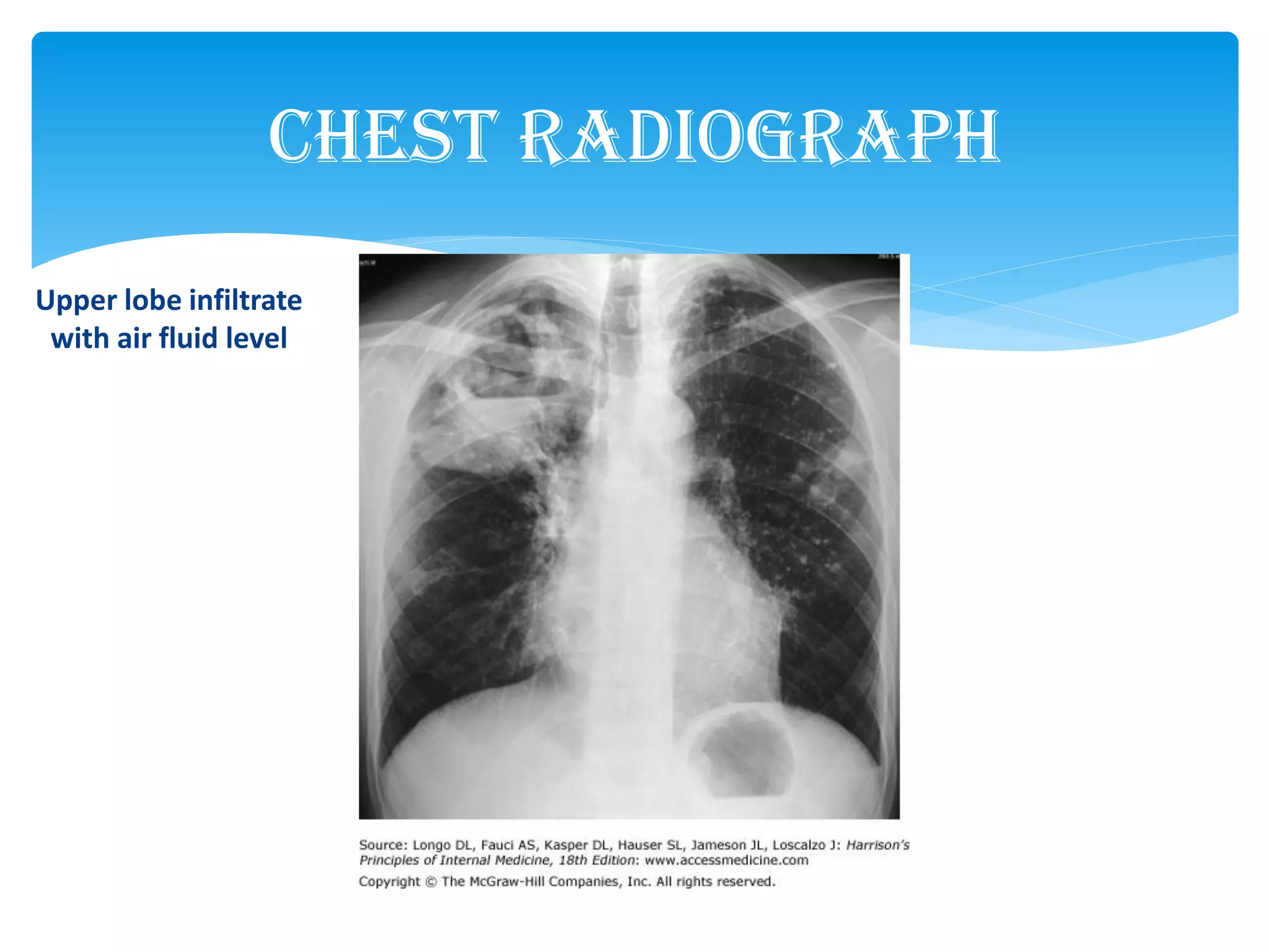 Chest Radiograph
Upper lobe infiltrate
with air fluid level
 