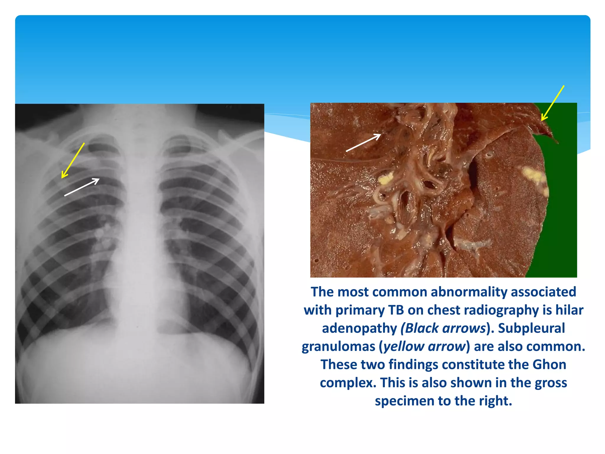 The most common abnormality associated
with primary TB on chest radiography is hilar
adenopathy (Black arrows). Subpleural
granulomas (yellow arrow) are also common.
These two findings constitute the Ghon
complex. This is also shown in the gross
specimen to the right.
 