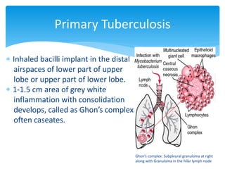  Inhaled bacilli implant in the distal
airspaces of lower part of upper
lobe or upper part of lower lobe.
 1-1.5 cm area of grey white
inflammation with consolidation
develops, called as Ghon’s complex which
often caseates.
Ghon’s complex: Subpleural granuloma at right
along with Granuloma in the hilar lymph node
Primary Tuberculosis
 