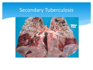 Secondary Tuberculosis
 