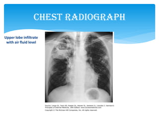 Chest Radiograph
Upper lobe infiltrate
with air fluid level
 