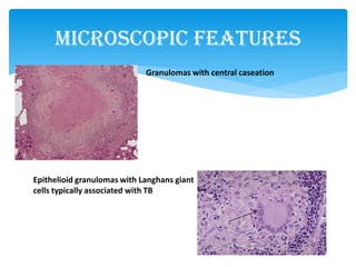 Microscopic Features
Granulomas with central caseation
Epithelioid granulomas with Langhans giant
cells typically associated with TB
 