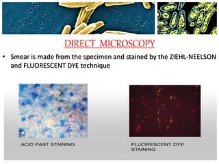 DIRECT MICROSCOPY
• Smear is made from the specimen and stained by the ZIEHL-NEELSON
and FLUORESCENT DYE technique
 