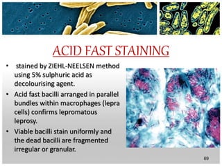 ACID FAST STAINING
• stained by ZIEHL-NEELSEN method
using 5% sulphuric acid as
decolourising agent.
• Acid fast bacilli arranged in parallel
bundles within macrophages (lepra
cells) confirms lepromatous
leprosy.
• Viable bacilli stain uniformly and
the dead bacilli are fragmented
irregular or granular.
69
 