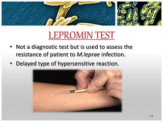 LEPROMIN TEST
• Not a diagnostic test but is used to assess the
resistance of patient to M.leprae infection.
• Delayed type of hypersensitive reaction.
71
 