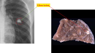 Ghon lesion
 