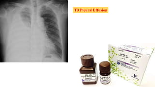 TB Pleural Effusion
 
