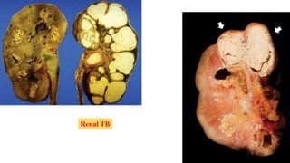 Renal TB
 