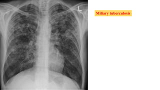 Miliary tuberculosis
 