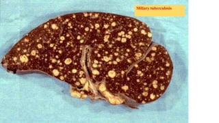 Miliary tuberculosis
 