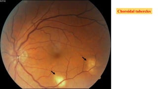 Choroidal tubercles
 