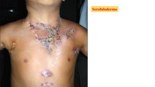 Scrofuloderma
 