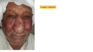 Lupus vulgaris
 