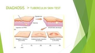 DIAGNOSIS > TUBERCULIN SKIN TEST
 