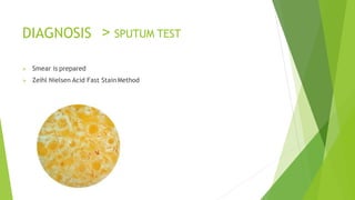 DIAGNOSIS > SPUTUM TEST
 Smear is prepared
 Zeihl Nielsen Acid Fast Stain Method
 