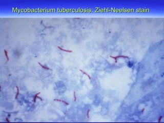 Mycobacterium tuberculosis: Ziehl-Neelsen stain  