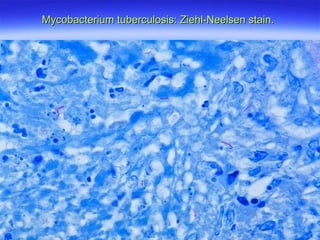 Mycobacterium tuberculosis: Ziehl-Neelsen stain.   