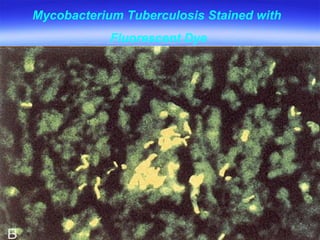 Mycobacterium Tuberculosis Stained with  Fluorescent Dye 