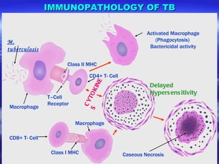 IMMUNOPATHOLOGY OF TB M. tuberculosis Macrophage Class II MHC Activated Macrophage (Phagocytosis)  Bactericidal activity T–Cell Receptor CD4+ T- Cell CYTOKINES CD8+ T- Cell Delayed Hypersensitivity Class I MHC Macrophage Caseous Necrosis 