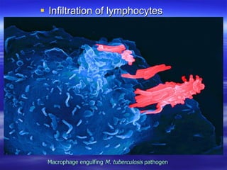Infiltration of lymphocytes Macrophage engulfing  M. tuberculosis  pathogen 