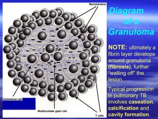 Diagram  of a Granuloma NOTE:  ultimately a fibrin layer develops around granuloma  (fibrosis) , further “walling off” the lesion. Typical progression in pulmonary TB involves  caseation ,  calcification  and  cavity formation . 