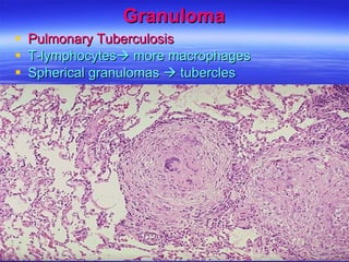 Granuloma Pulmonary Tuberculosis T-lymphocytes   more macrophages Spherical granulomas    tubercles 