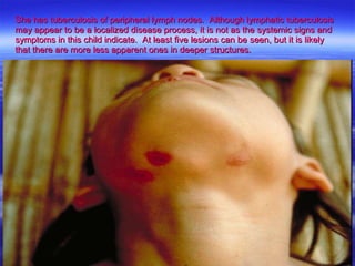 She has tuberculosis of peripheral lymph nodes.  Although lymphatic tuberculosis may appear to be a localized disease process, it is not as the systemic signs and symptoms in this child indicate.  At least five lesions can be seen, but it is likely that there are more less apparent ones in deeper structures.  
