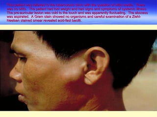 This patient was referred to the tuberculosis clinic with the question of otitis media.  There was no otitis.  The patient had lost weight and had signs and symptoms of systemic illness.  The pre-auricular lesion was cold to the touch and was apparently fluctuating.  The abscess was aspirated.  A Gram stain showed no organisms and careful examination of a Ziehl-Neelsen stained smear revealed acid-fast bacilli. 