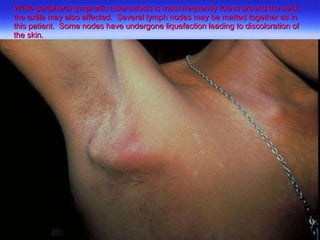 While peripheral lymphatic tuberculosis is most frequently found around the neck, the axilla may also affected.  Several lymph nodes may be matted together as in this patient.  Some nodes have undergone liquefaction leading to discoloration of the skin. 