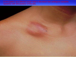 In this patient, any affected lymph node in the lesion had undergone complete caseation with discoloration of the skin. 