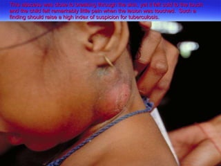 This abscess was close to breaking through the skin, yet it felt cold to the touch and the child felt remarkably little pain when the lesion was touched.  Such a finding should raise a high index of suspicion for tuberculosis. 
